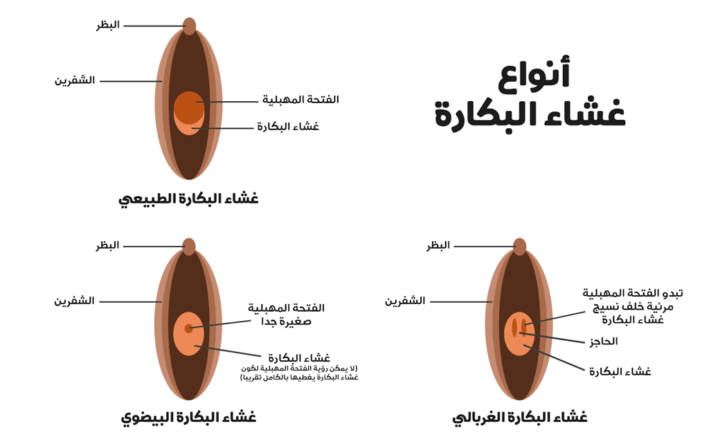 تكلفة عملية ترقيع البكارة - كيفية حدوث عملية الترقيع لغشاء البكارة 5405