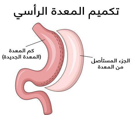 عملية قص المعدة في الاردن 6210