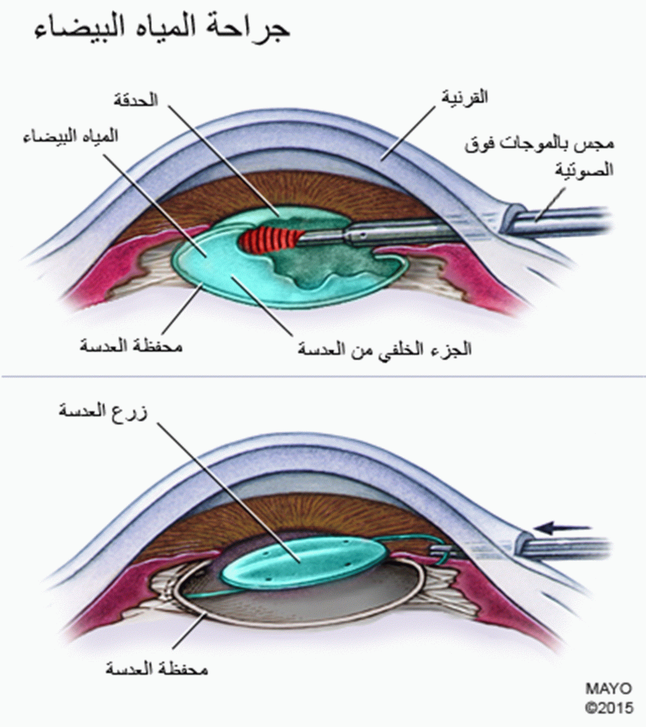 اسباب المياه البيضاء في العين , تعرفوا ما سبب المياه البيضاء