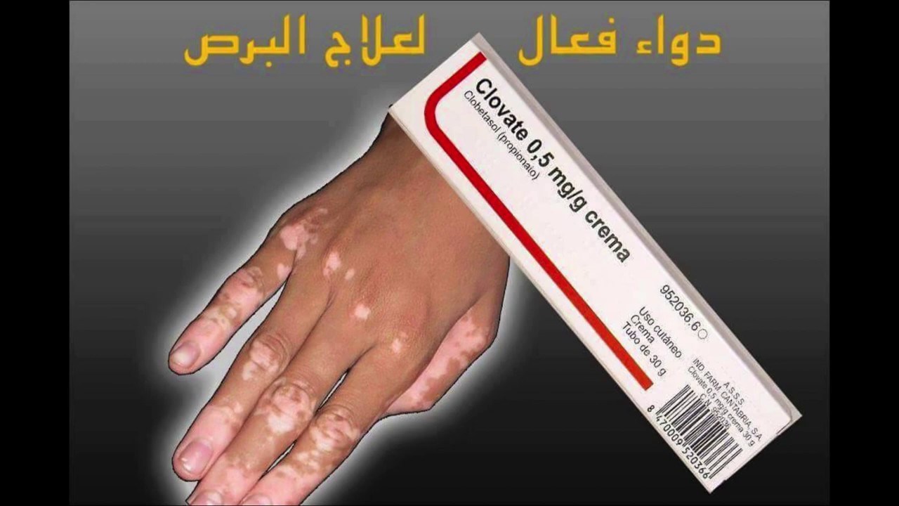 علاج البرص مجرب- اسباب البرص واهم علاجه 6768 1