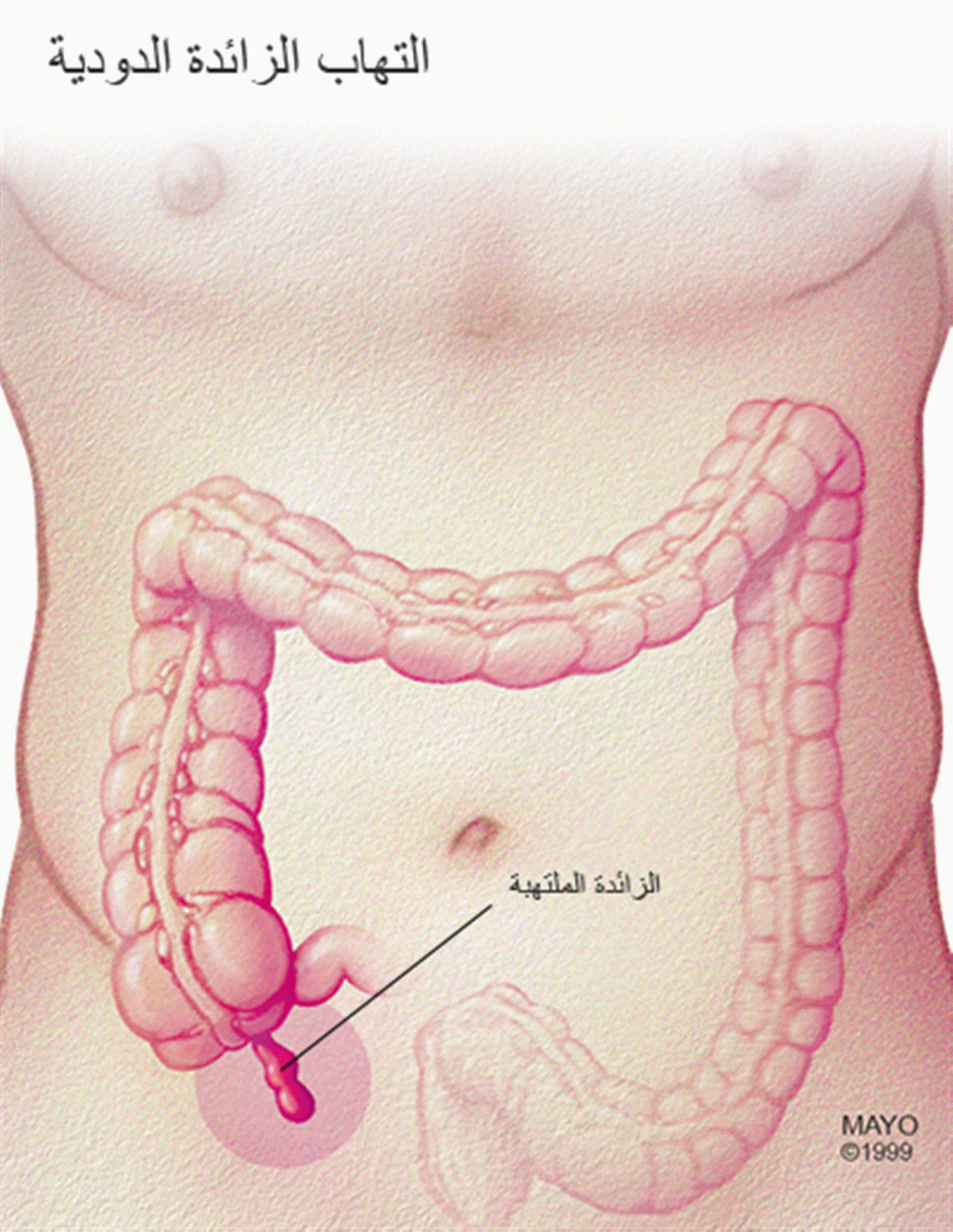 اين توجد الزائدة الدودية- اعراض وعلامات ومكان الزائده الدوديه 6647 1