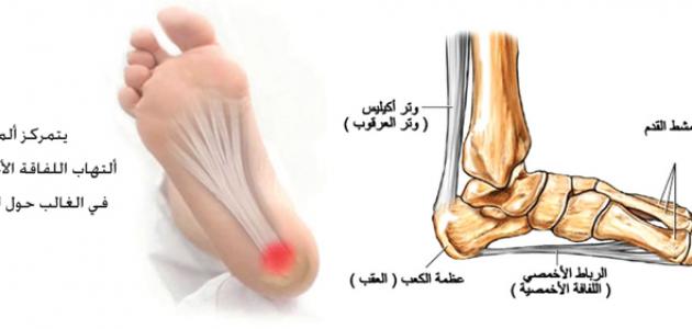 الام مشط القدم , اسبابه واعراضه وطرق علاجه