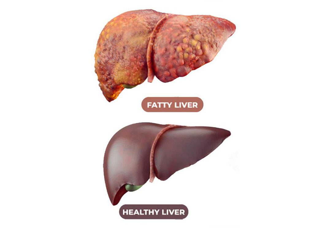 علاج الكبد الدهني , القضاء على دهون الكبد المميته