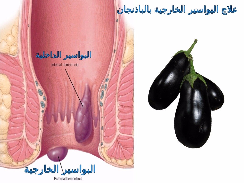 مدة علاج البواسير الخارجية , الوقت الكافى لعلاج البواسير