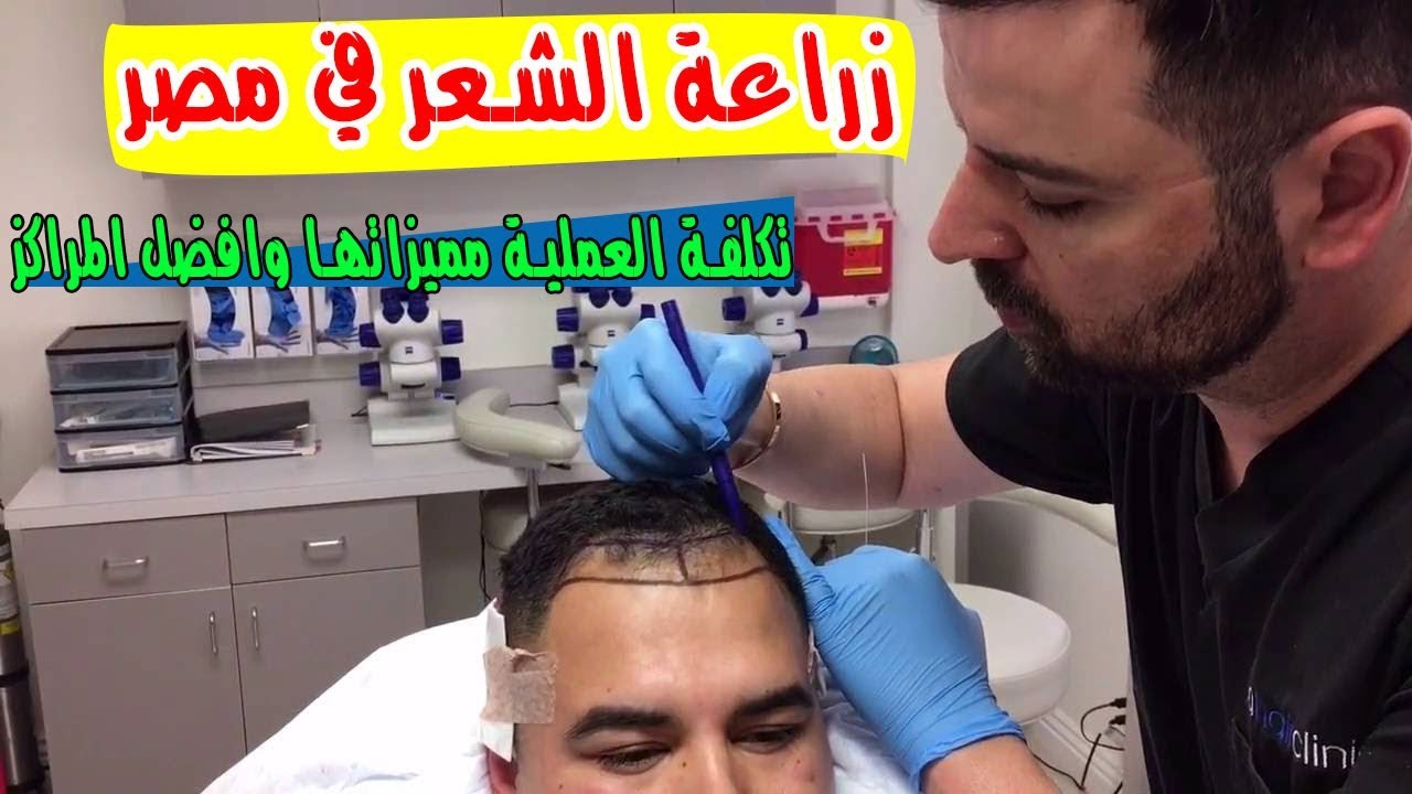 زراعة الشعر في مصر , يلا نشاهد شكل الشعر بعد الزرع