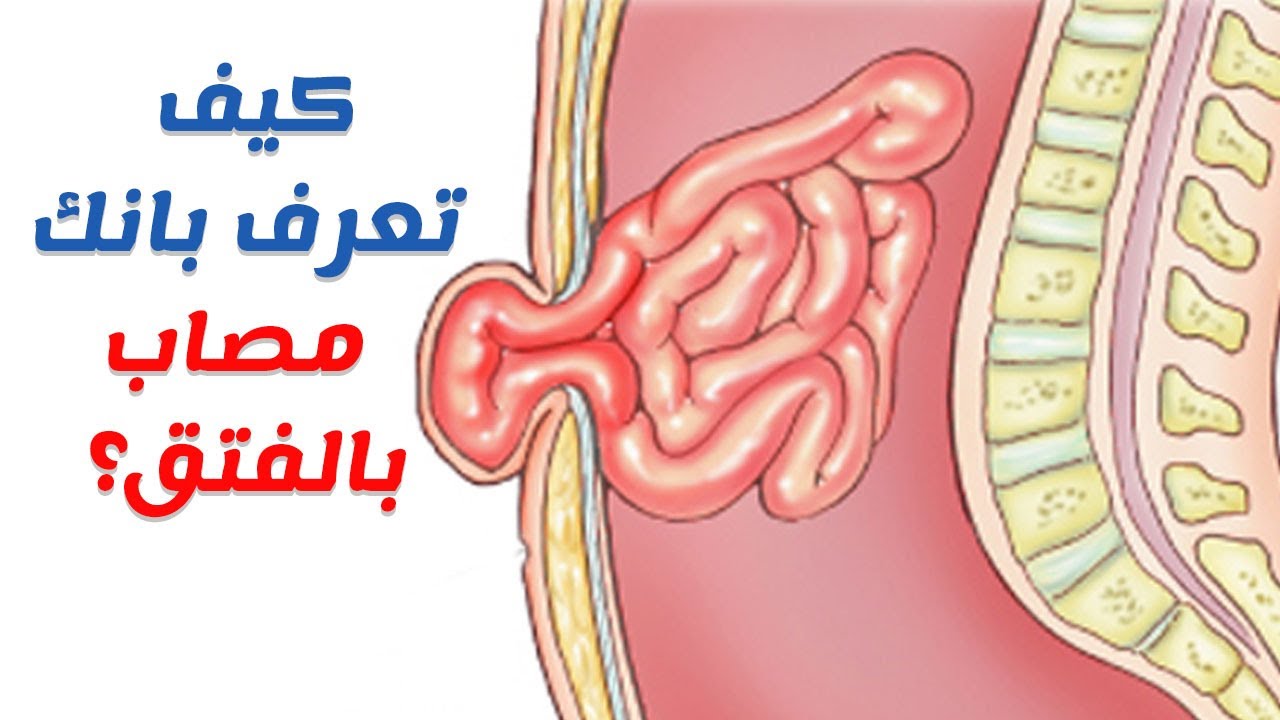 اعراض فتق البطن - ما الاسباب التى تسبب فتق البطن 2082 1