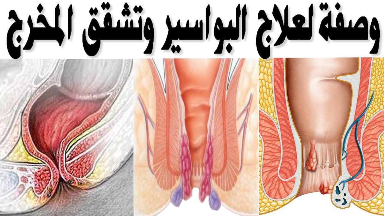 علاج جرح في المخرج- اسباب واعراض وعلاج مرض الشرخ 6042 2