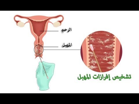 علاج الافرازات المهبلية البيضاء , طريقه علاج الافرازات المهبيله