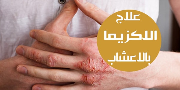 علاج الاكزيما بالاعشاب - علاج الاكزيما دون تدخل الطبيب 5503 2