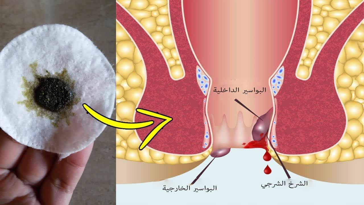 علاج جرح في المخرج- اسباب واعراض وعلاج مرض الشرخ 6042 3