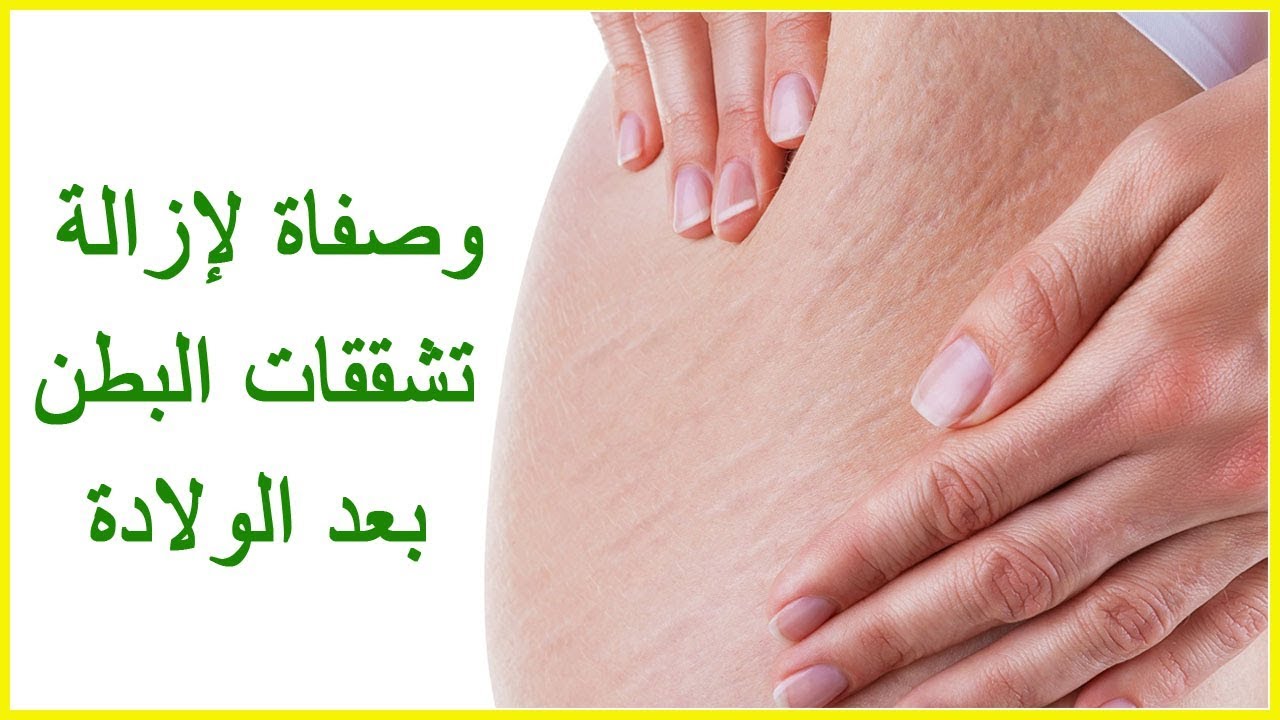 علاج تشققات البطن , اسباب ظهور علامات في البطن وعلاجها