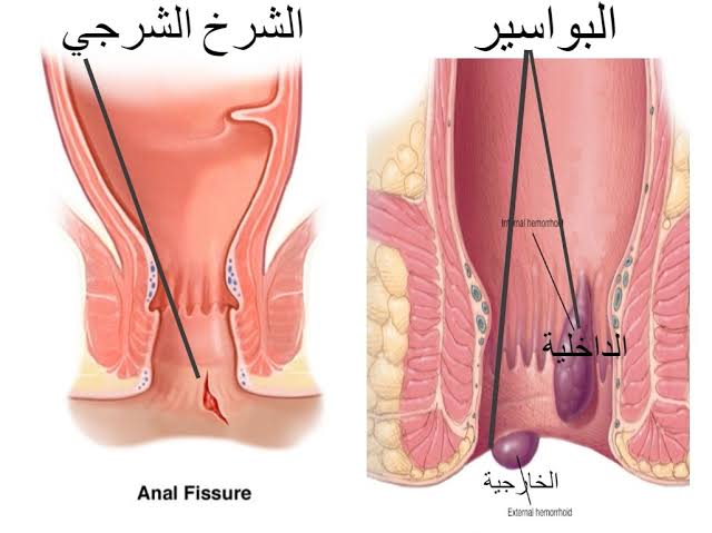 علاج البواسير الداخلية , طرق بسيطة لعلاج البواسيرالداخلية