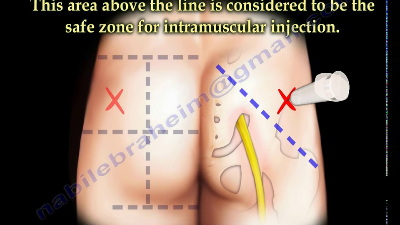 طريقة اعطاء الحقن العضلية بالصور , تعلم كيفيه اعطاء حقن العضل بدون الم
