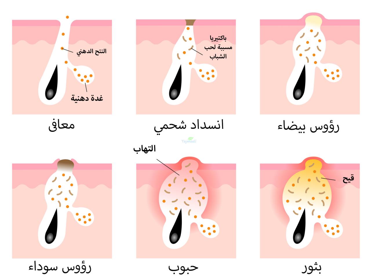 وصفات للتخلص من الرؤوس السوداء- طرق مختلفه هتخليكي زي القمر وتتخلصي من الرؤوس السوداء 5708 6