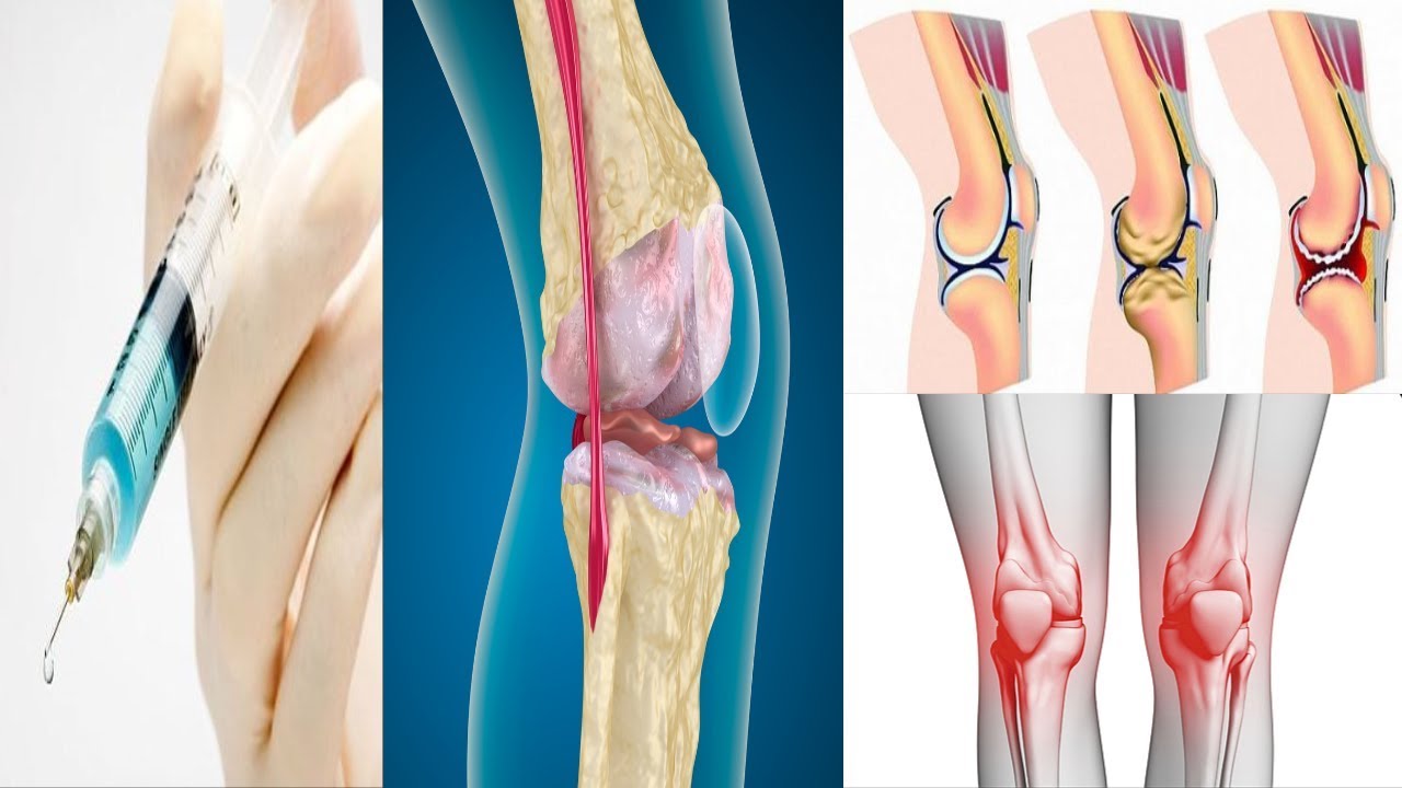 الام المفاصل اسبابها وعلاجها - طرق علاج امراض العظام واسبابها 4018 2