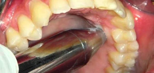 الاسنان الضرس خراج طرق علاج لعلاج والضروس
