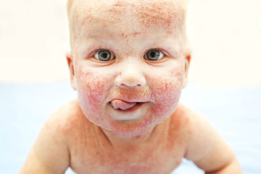 انواع حساسية الجلد عند الاطفال تاثر جلد الاطفال بامراض متنوعه تعرف عليها رهيبه