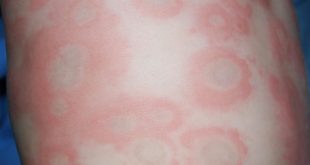 الاطفال الجلد انواع بامراض تاثر تعرف جلد حساسية عليها عند متنوعه