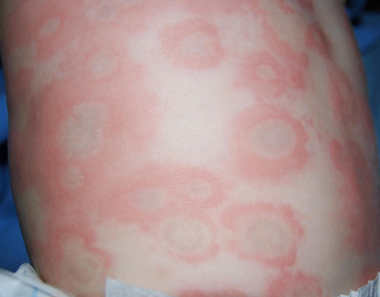 الاطفال الجلد انواع بامراض تاثر تعرف جلد حساسية عليها عند متنوعه