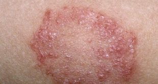 اسماء الامراض الجلدية الجلديه تعرف على كل من نوع