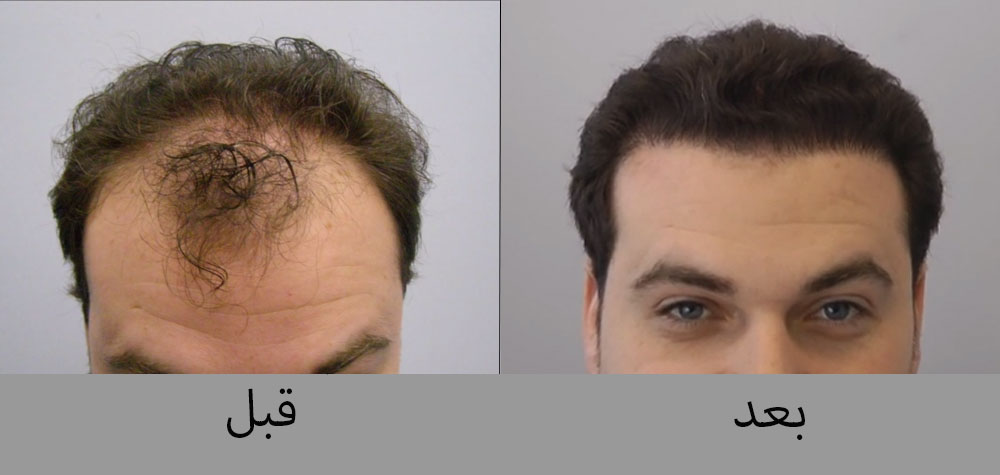 الرجل الثلجي وعاء خصم اسعار زراعة الشعر في السعودية rosedalemasterplan com