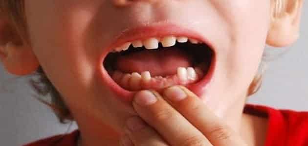 الاحلام الاسنان المنام تساقط تفسير في