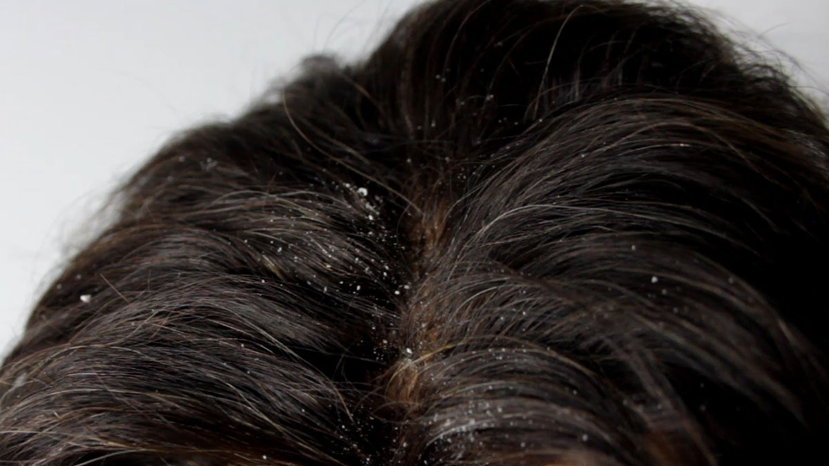 التخلص الشعر طريقة علاج قشرة كيفية من