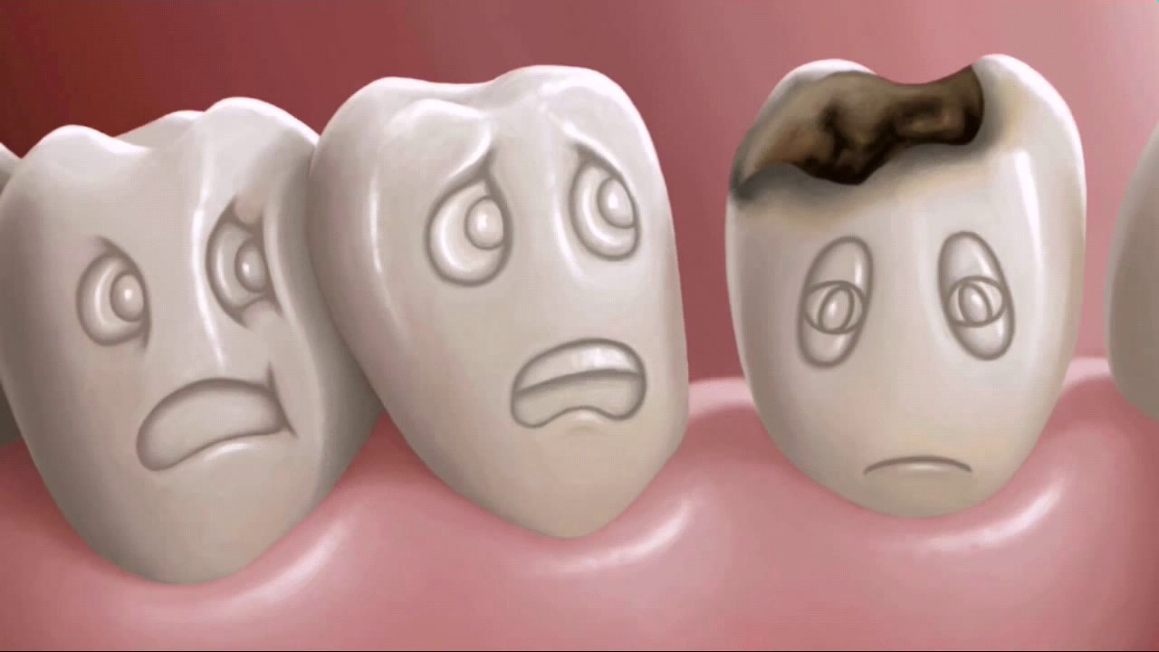 اسباب اصابة الاسنان الاطفال بتسوس تسوس للاطفال