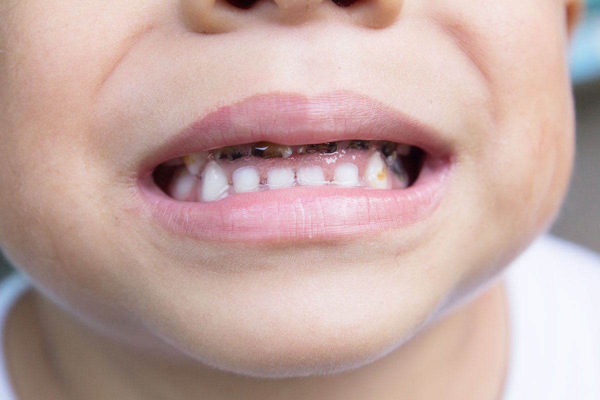اسباب اصابة الاسنان الاطفال بتسوس تسوس للاطفال