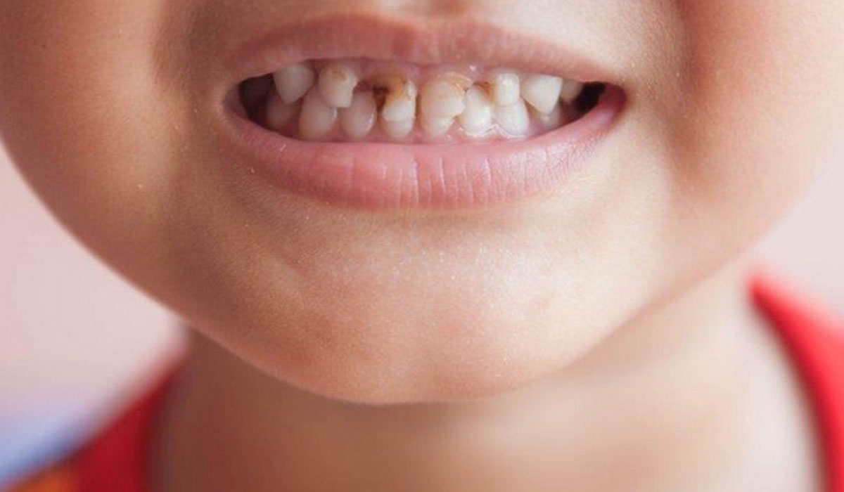 تسوس الاسنان للاطفال , اسباب اصابة الاطفال بتسوس الاسنان - رهيبه