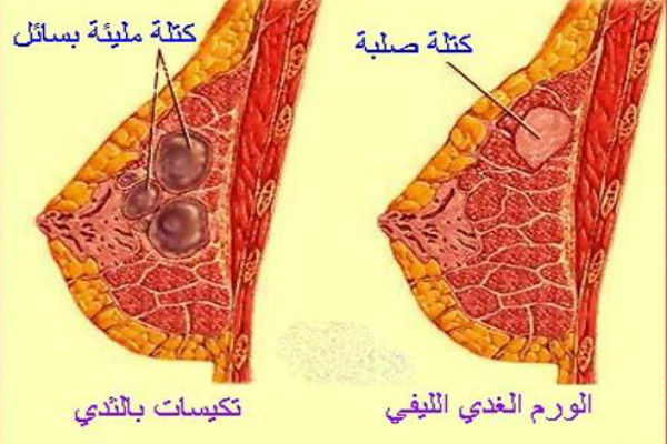 الاورام الليفي الليفيه الورم انواع علاج
