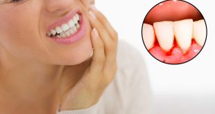 ازاي اسنانك البيت التهاب اللثة بالاعشاب تعالج علاج في والاسنان
