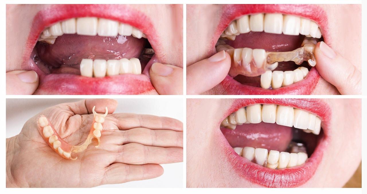 اسنانك الاسنان بكل تركيب ركب سهولة طريقة
