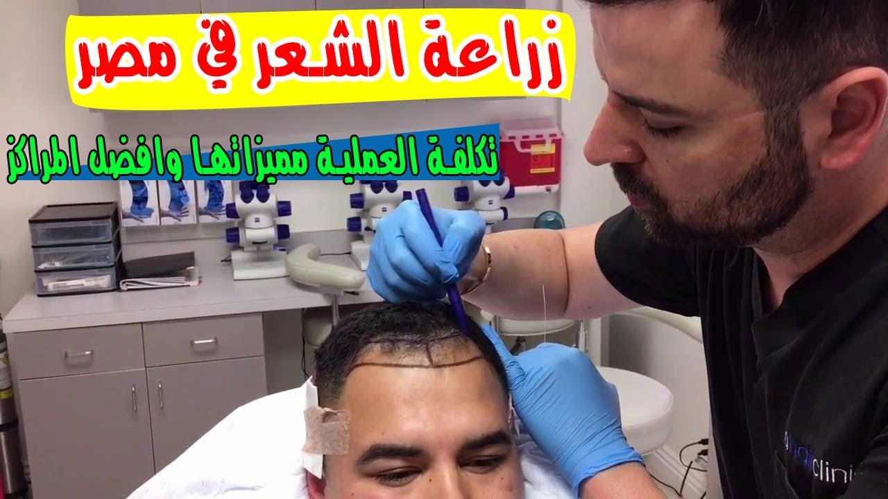 الزرع الشعر بعد زراعة شكل في مصر نشاهد يلا