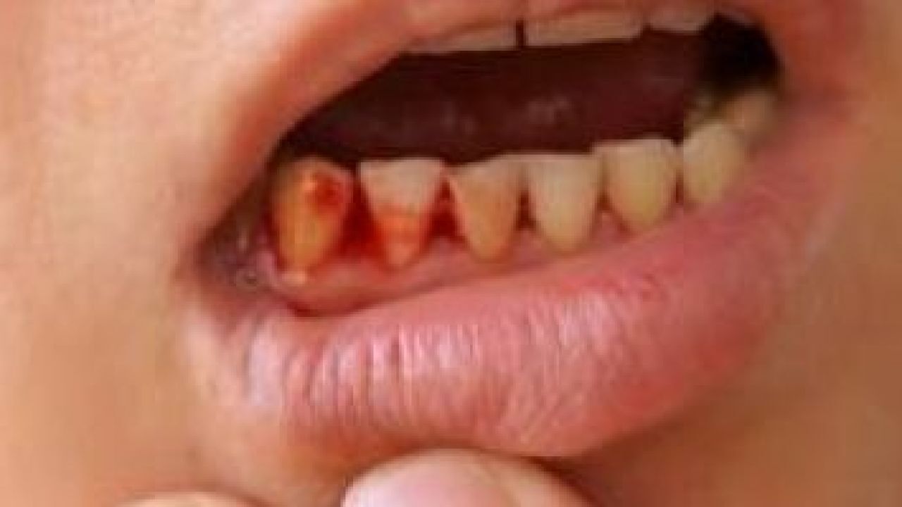 اعراض الدم الفم خروج سبب لعلاج من واسباب ونصائح